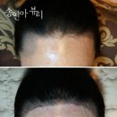 수정헤어라인 네이버블로그