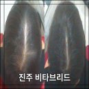 개양로 | 진주 탈모관리 비타브리드 3개월 케어 후기
