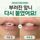 예온 | 검단신도시 예온치과병원 내돈내산 후기｜아이 앞니가 반으로 부러졌어요