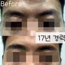 더블류성형외과 네이버블로그