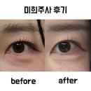 (주)큰사람유통 신촌 | 신촌피부과 미희주사 콜라겐주사 효과 [눈밑 다크써클 한톤 밝아진 후기]
