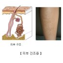 피부건조증 ...... 이미지