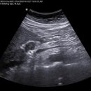 neurogenic tumor (CT 결과) 이미지