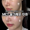 그레이스셀강남병원 | 영등포 피부과 줄기세포 피부주사 효과 통증 후기 mct 메타셀 내돈내산