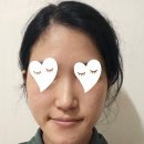 인더라인 | 자연유착 인아웃라인 쌍수 후기 전후 사진 있음 (1주~6주)