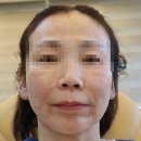 장덕한방병원 | 서초장덕한방병원 타임리프팅 내돈내산 후기(일주일차)