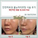 고려에너지1호 | 인천 구월동피부과 볼뉴머리프팅 600샷 시술후기(통증 및 전후효과비교)