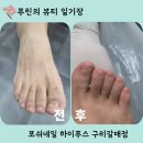 구리 내성발톱 포쉬네일 하이푸스 구리갈매점 ㅣ 발톱무좀,발각질 고민까지 한번에 케어! 후기