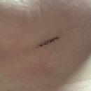 푸름약국 | 얼굴 돌출점/큰점 제거 후기 | 1년 총정리 | 수박씨 점 안녕