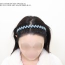 4088 | 여자모발이식 절개 4088모 후기｜10대 M자 이마 헤어라인 자연스럽게 바뀐 사례