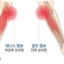 팔꿈치 통증 증상 테니스엘보 골프엘보 이미지