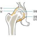 무혈성괴사란~~ 이미지