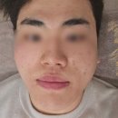 헬리오스 | 서면 피부과 색소레이저 헬리오스 로투스 후기