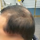 김호증모가발by헤어리서치