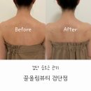 솔로몬메디컬 | 검단 승모근관리 끌올림뷰티 제니어깨 직각어깨 만들기 웨딩관리