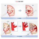 뇌졸중 환자의 재활 이미지