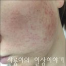 리유네일 - 남구 팔등로 8 | 리유한의원 신촌점 모낭염 완치 후기 낋여옴!!