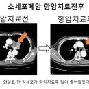 소세포폐암의 진단과 치료 이미지
