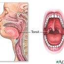 편도선 및 아데노이드 수술 이미지