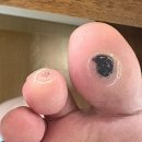 차오름약국 | [사마귀약/엔드와츠] 6일차 ~10일차(극혐 사진 주의)