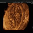 수정-16 | 인공수정 쌍둥이 임신12주, 16주 기형아검사 종류 후기