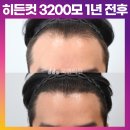 [20대 남성 소핥은 머리 헤어라인 교정 후기] 비절개 히든컷 3200모 모발이식 1년 전후 (모엠의원/M자탈모/전지훈원장) 이미지