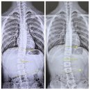 CU 그린자이점 | 중학생 남자아이 척추측만 교정 후기
