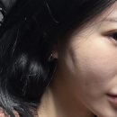 콜 | 잠실피부과 옆볼꺼짐콜라겐주사 미라콜 후기내돈내산 (결절, 부작용)
