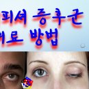 사암침, 사암침법 - 밀러피셔 증후군 치료 방법 - 비과학적 양의학 110 이미지