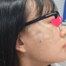 지니스안경김포구래점 | 김포 구래역 피부과 _ 잡티제거 일주일후기(편평사마귀, 흑자 레이저 시술)