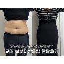 개인택시 영양군지부 | 교대 복부 지방흡입 5kg감량 수술 당일 준비물 통증, 붓기, 한달차 변화 후기