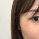 새별약국 | [원주 피부과 추천] 이틀만에 새살이 솔솔 돋은 신기한 매직