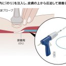 다리의 정맥류, 「접착제」주입으로 치료 통증이나 합병증 적어 이미지