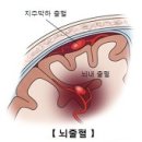 뇌출혈(Cerebral hemorrhage) 이미지