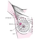 서울엘내과의원 | [34]유방암 수술전 진료, 감시림프절 생검 생략 임상