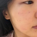 아셀 - 안양시 동안구 평촌대로374번길 9-7 | [홍대피부과] : ECM 스킨부스터 쥬브아셀 내돈내산 후기