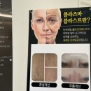 거성메디칼판매(대구지사) | 대구 아미뷰티 , 트리플플라즈마/콜드플라즈마 여드름흉터제거 (2주 후기)