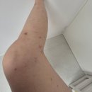 소로3-32 | 32주차 임신소양증 아주대 피부과 치료후기