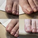 서창제일의원 | 인천내성발톱 골칫거리 내성발톱 싹 다 해결