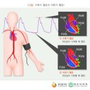 고혈압의 종류, 원인 및 위험요인, 증상 및 합병증 이미지