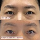 이진쵸이스