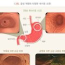 위염 원인 급성 위염 미란성 위염 이미지