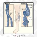 하지정맥류병원 선택, 재발 및 부작용이 걱정되어 망설여진다면? 이미지