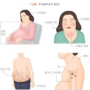 [달덩이 같은 얼굴 _ 문 페이스 (쿠싱증후군 Cushing’s syndrome)] _ 문정동필라테스 리업필라테스 이미지