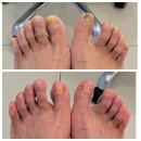 푸스케어 마곡점 | 마곡 발톱무좀 전문점. 발톱무좀, 내성발톱,발각질 등 다양한 문제성발톱 전문 푸스케어 마곡점 관리후기