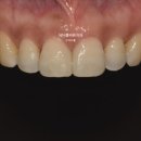 연우치과의원 | 강남 치과, 벌어진 앞니 무삭제 라미네이트 치료 후기