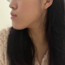 바른턱얼굴치과의원 | 저 주걱턱 교정기 하고, 양악 효과 봤어요! 6개월 후기
