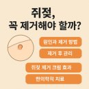 산성바른한의원 | 쥐젖(연성섬유종), 꼭 제거해야 할까? – 원인부터 치료까지