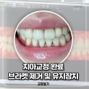 (주)치아세상 | 교정일기 #12 브라켓 제거 및 유지장치 치아 교정 완료