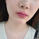 다죠아 | 쥬브겔 입술필러 후기 통증 가격 다운타임